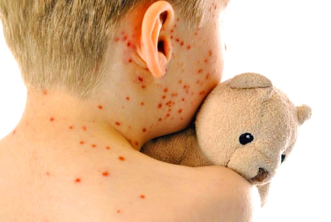 Carate, il virus del morbillo torna a far paura