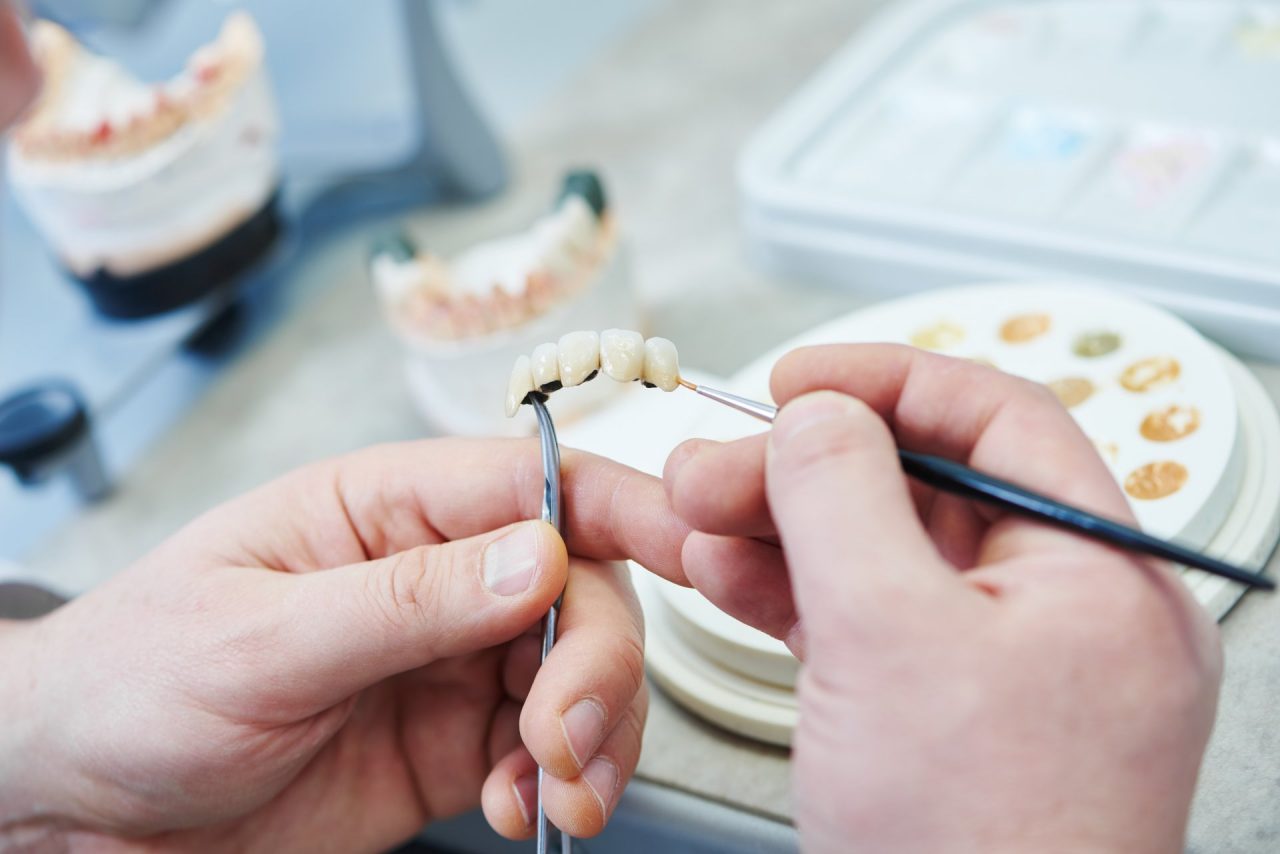Protesi dentali fisse, mobili e rimovibili con Dental System