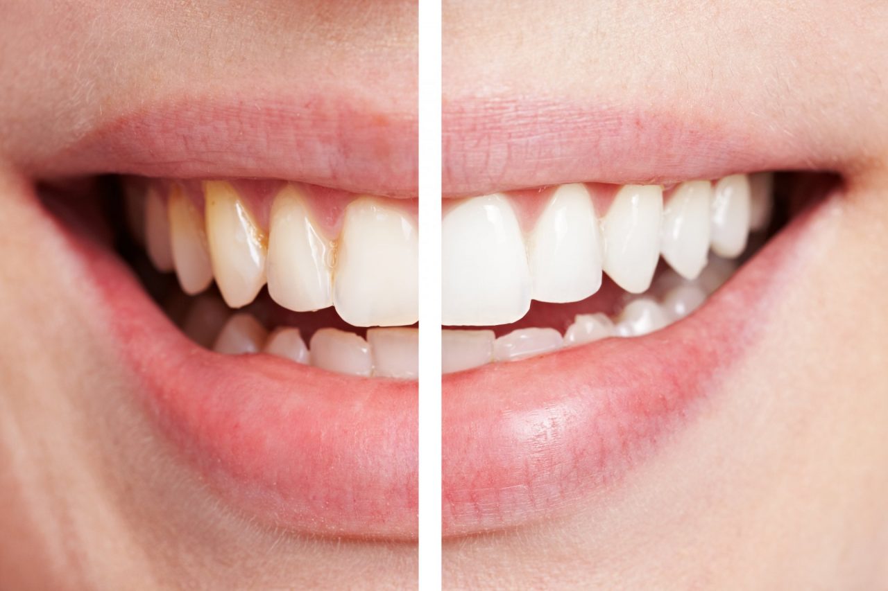 Sbiancamento dentale professionale per denti macchiati e ingialliti: scopri cause e soluzioni per le macchie sui denti