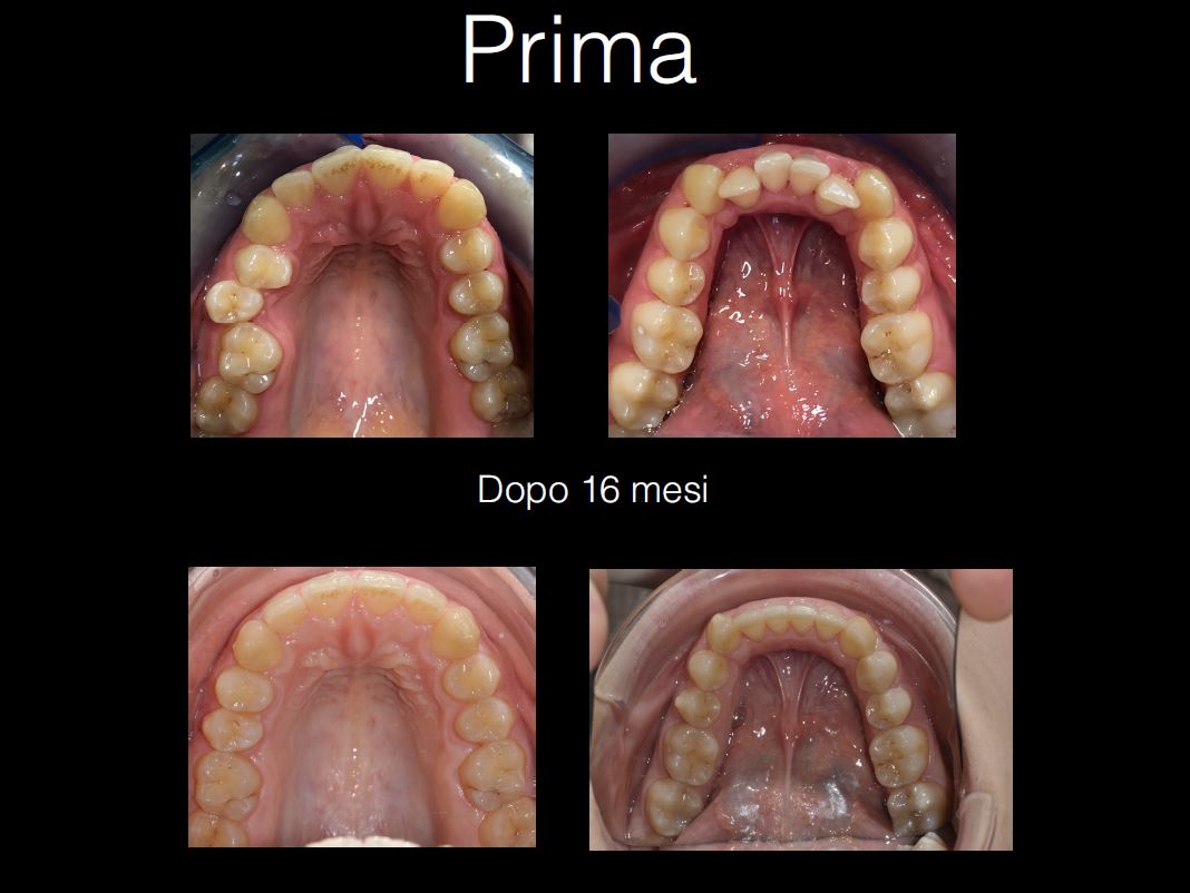 mezzena_prima-dopo_2