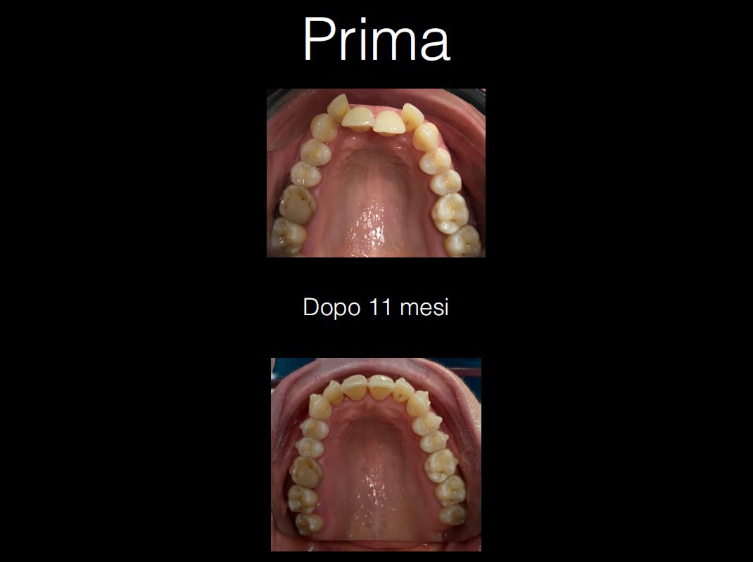 mezzena_prima