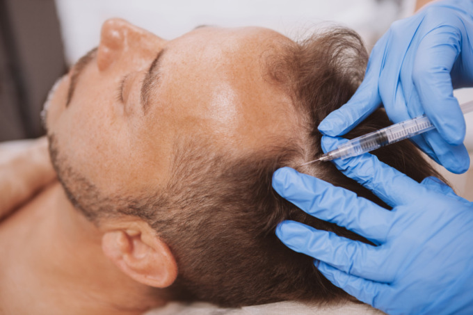 Trapianto capelli uomo: bastano 3 minuti per l’analisi gratuita