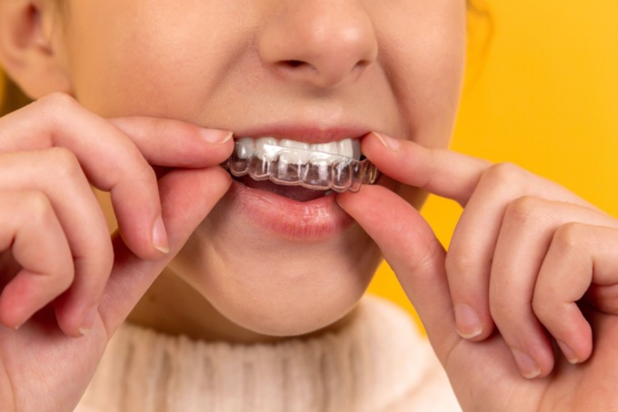 Pro e contro degli apparecchi dentali