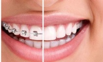 Denti storti e ortodonzia invisibile: nello Studio del dottor Barbaro salute ed estetica del sorriso vengono prima di tutto