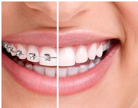 Denti storti e ortodonzia invisibile: nello Studio del dottor Barbaro salute ed estetica del sorriso vengono prima di tutto