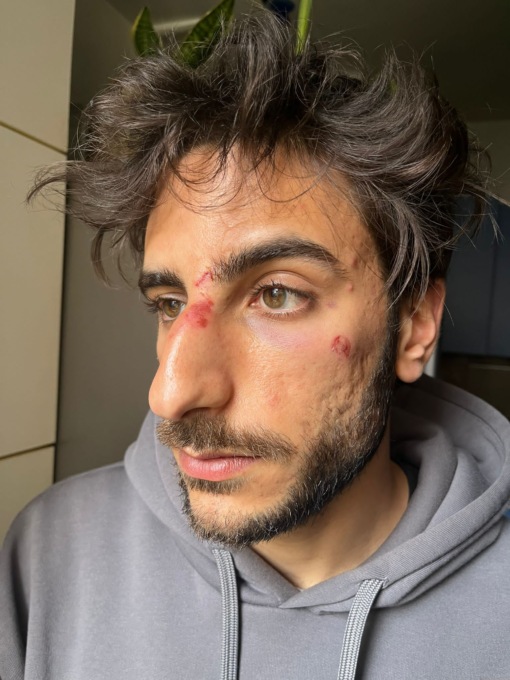 Picchiato e minacciato dopo la partita: “Mi hanno aspettato fuori e rotto il naso”