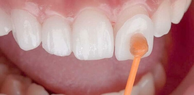 Anche a Bellusco sempre più richieste: faccette dentali, estetica e funzione