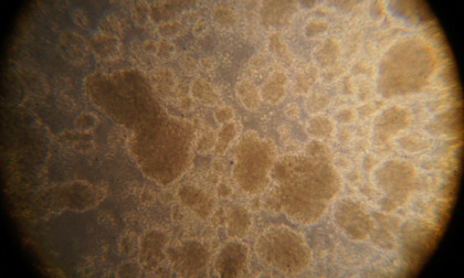 Leucemia infantile, svelato il meccanismo di sopravvivenza delle cellule