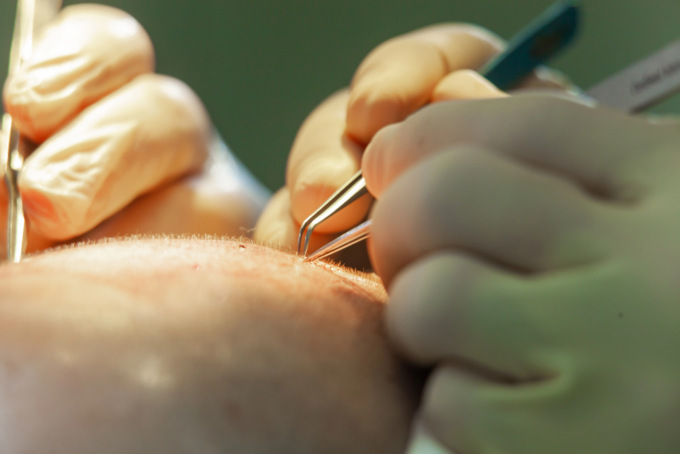 Trapianto di capelli in Turchia, tecniche e vantaggi