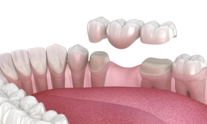 Dentista e piano terapeutico sono fondamentali nella scelta tra ponte e impianto dentale