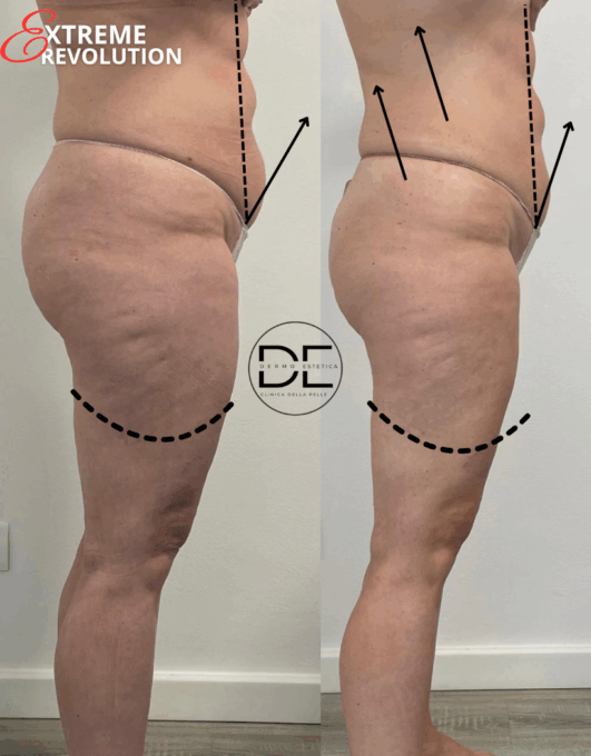 Carbossiterapia senza aghi: la nuova frontiera dell’estetica avanzata è firmata Dimensione Estetica