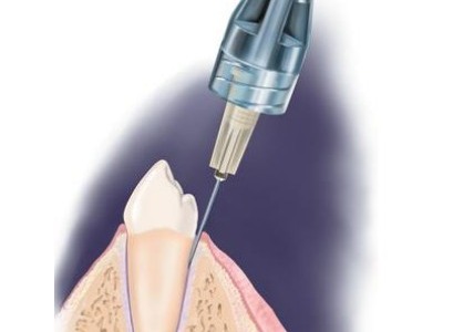 L’anestesia digitale in odontoiatria: un passo avanti verso il comfort del paziente