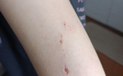 Ragazzina ferita  da un cane e il padrone scappa