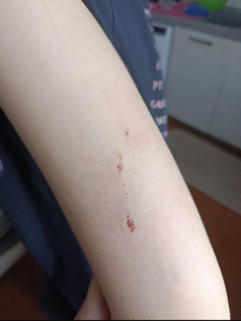 Ragazzina ferita  da un cane e il padrone scappa