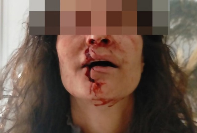 Sfregiò la vicina, condannata a otto anni di carcere