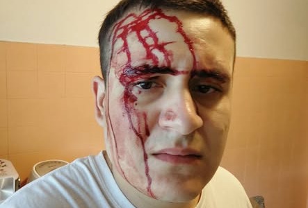 Aggredito mentre fa jogging da un uomo mascherato e colpito con un tirapugni