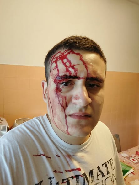 Aggredito mentre fa jogging da un uomo mascherato e colpito con un tirapugni